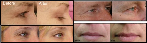 DPL Therapy System before and after shots