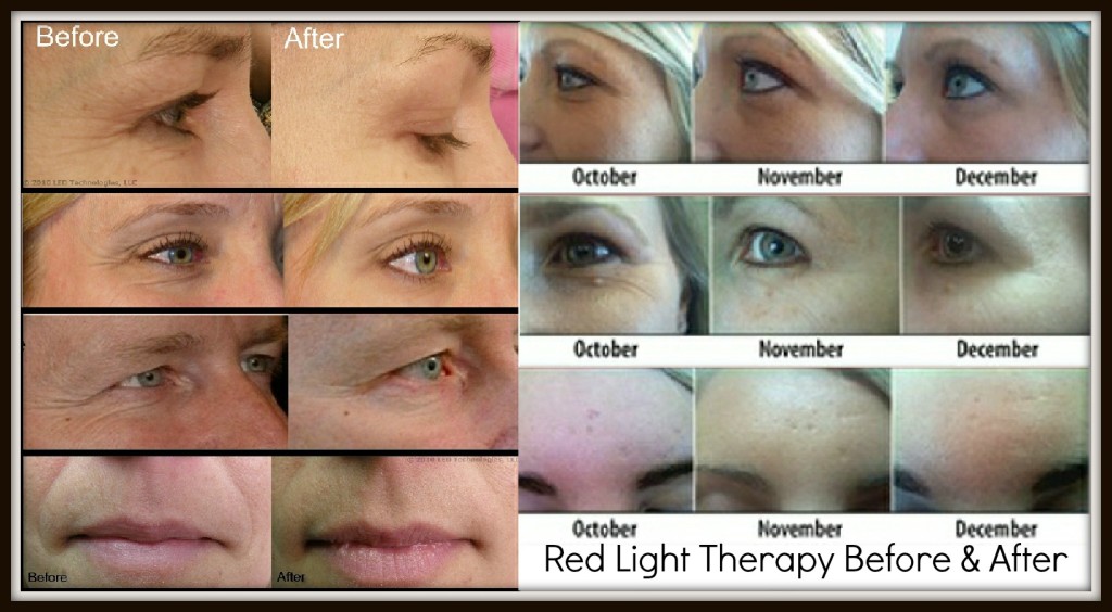 Red LED light therapy before and afters