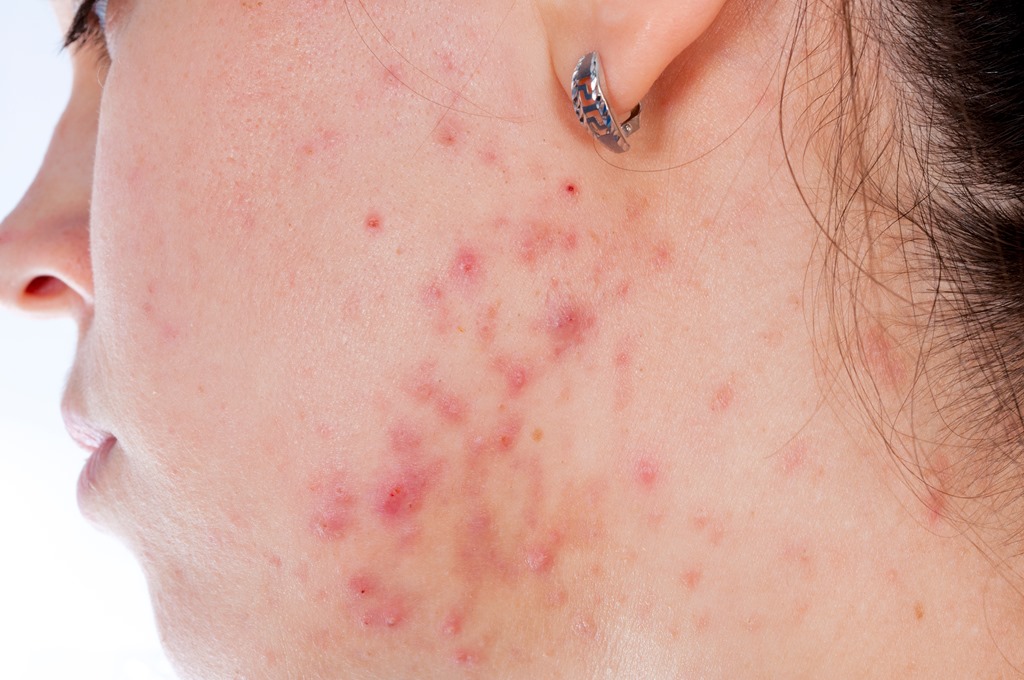 Know a Teen Suffering with Acne Relief is just a Wavelength Away 