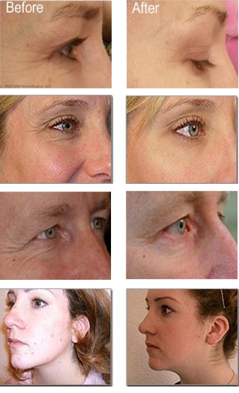 Red Light Therapy For Skin Before And After