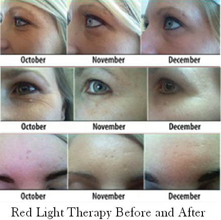 Top 30 of Red Light Therapy Before And After Body